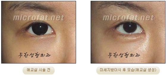 Duhan Plastic Surgery Under-Eye Surgery - Correction with Fat Grafting After Aegyo-Sal Filler image 20