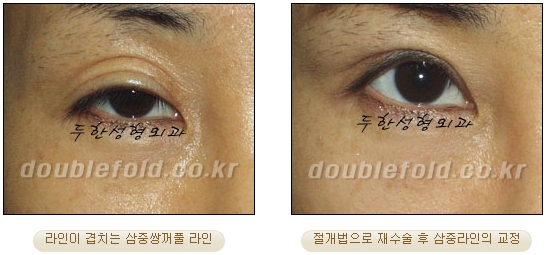 [두한성형외과 눈재수술] - [재수술 방법들] 관련 이미지 22