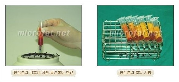​[두한성형외과 경쟁력 지방이식] - [지방이식 부작용 이후 마이크로 지방흡입, 마이크로 지방흡입 이후 부작용 없는 지방이식 방법] 관련 이미지 13