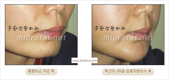 [두한성형외과 경쟁력 안면윤곽 교정] - [자연스럽고 균형있는 턱으로의 복원 미세지방이식과 간편 사각턱 보톡스 안내] 관련 이미지 12