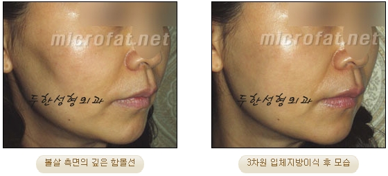 얼굴지방이식 두한성형외과 - 볼지방이식 관련 이미지 24
