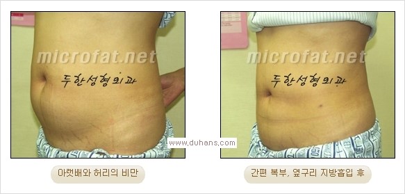 [두한성형외과 경쟁력 지방흡입] - [초음파 지방흡입과 미세흡입관을 이용한 간편지방흡입] 관련 이미지 13