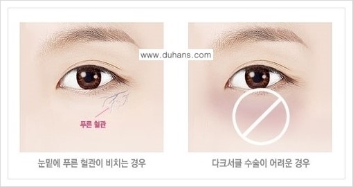 [두한성형외과 경쟁력 다크써클 교정] - [다크써클 5단계로 이뤄지는 핵심 5 STEP SOLUTION 안내 1.] 관련 이미지 6