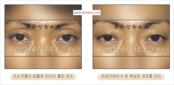 [두한성형외과 경쟁력 쌍꺼풀 재수술 리더] - [풀린 쌍꺼풀, 풀려버린 쌍꺼풀 재수술 방법 안내] 관련 이미지 7