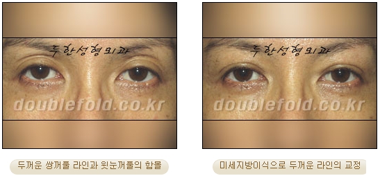 [두한성형외과 쌍커풀수술] - [눈성형 방법에 대한 자주하는 질문과 답변] 관련 이미지 90