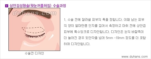 [두한성형외과 경쟁력 눈성형] - [상큼하고 환한 젊은 눈매 상안검성형(윗눈꺼풀 처짐) 안내] 관련 이미지 1