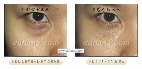 [두한성형외과 상큼하고 환한 눈매완성] - [눈밑 미세지방이식 ②] 관련 이미지 3