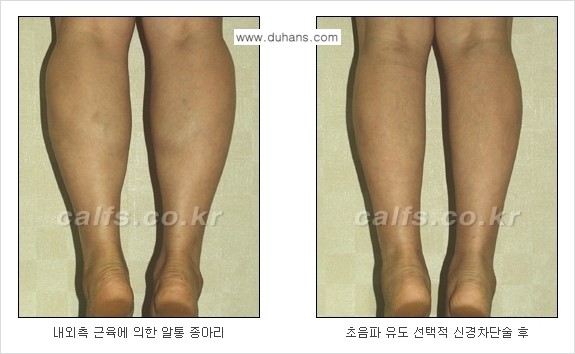 ​[두한성형외과와 날씬한 종아리 만들기!] - [간편하고 안전한 종아리 축소방법 ④] 관련 이미지 13