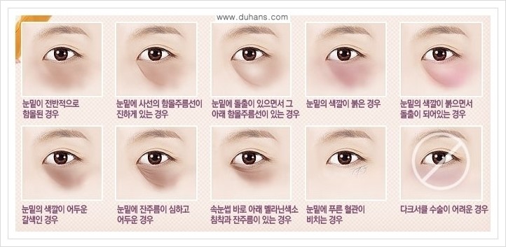 [두한성형외과 경쟁력 눈밑성형] - [눈밑 다크써클 증상과 그 증상에 맞는 치료 방법 안내] 관련 이미지 1