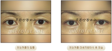 [Doohan Plastic Surgery Autologous Fat Grafting] - [Sunken Eye Fat Grafting] image 13