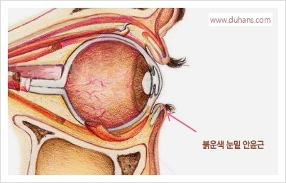 [두한성형외과 경쟁력 눈밑성형] - [다크써클 치료 실패의 원인 - 레이저 치료, 필러로 교정, 잘못된 적응증의 지방재배치] 관련 이미지 3