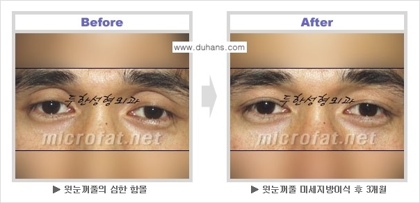 [두한성형외과 NO 1. "Col-fat 지방이식"] - [지방이식의 지속효과, 오해와 진실, 부작용] 관련 이미지 5