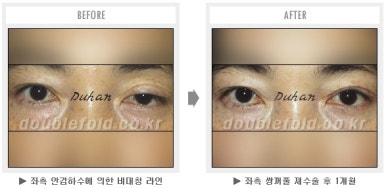 두한성형외과 쌍커풀 재수술 - 짝눈 눈매교정, 가성 안검하수 교정과 뒤밑트임 관련 이미지 43