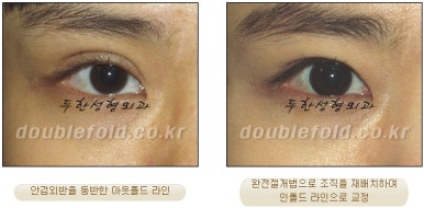 [두한성형외과 쌍커풀재수술] - [심한 소세지눈, 두줄따기, 쌍꺼풀 흉터] 관련 이미지 25