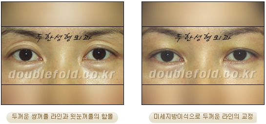 [Eye Reoperation Duhan Plastic Surgery] - [Guide to Double Eyelid Revision Surgery] image 48