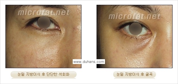 [두한성형외과 "미세지방이식"] - [지방이식 부작용 교정 정보 ①] 관련 이미지 8