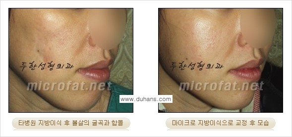 [두한성형외과 경쟁력 미세지방이식] - [타 병원에서 볼살 지방이식 이후 부작용 교정 방법 안내] 관련 이미지 8