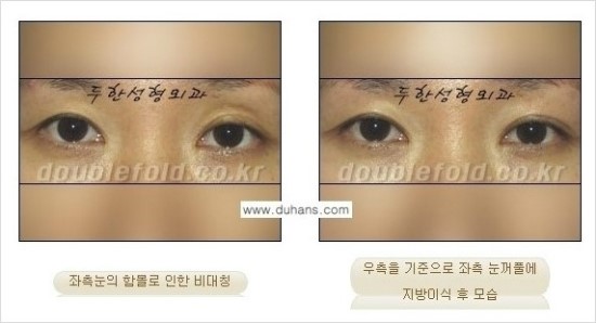 [두한성형외과 경쟁력 눈성형] - [쌍꺼풀 재수술 과정과 쌍꺼풀 재수술 실패의 원인, 쌍꺼풀 재수술의 성공 요건] 관련 이미지 42
