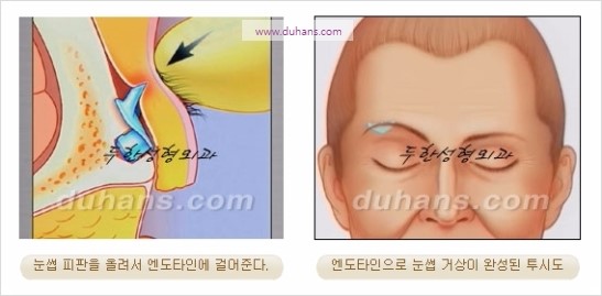 [두한성형외과 주름성형] - [주름교정술 - 강력한 리프팅 파워 엔도타인 리프팅 ] 관련 이미지 33