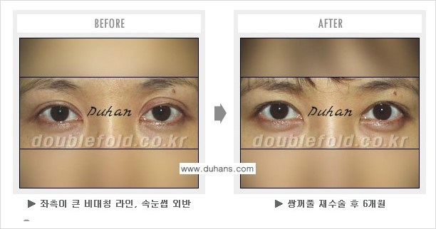 [두한성형외과 NO.1 쌍꺼풀 재수술, 극한 재수술] - [안검하수 교정이 불가능할 경우의 문제점 해결 안내] 관련 이미지 3