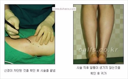 [두한성형외과 Dr. 컬럼 - 타 병원의 종아리 퇴축술 이후 문제가 발생한 경우] 관련 이미지 11