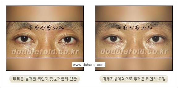 쌍꺼풀 재수술 Dr. 컬럼 관련 이미지 3