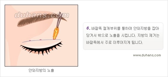 ​[두한성형외과 경쟁력 눈성형] - [자연스럽고 아름다운 쌍꺼풀의 기준] 관련 이미지 12