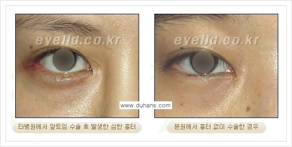 [두한성형외과 경쟁력 눈성형] - [흉터없는 몽고주름 제거 - 앞트임 수술 안내] 관련 이미지 6