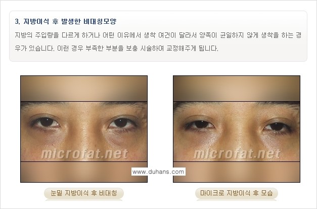 [두한성형외과 "미세지방이식"] - [지방이식 부작용 교정 정보 ③] 관련 이미지 3