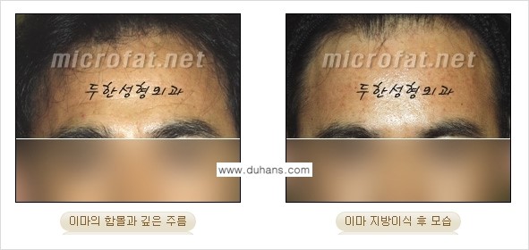 [두한성형외과의 경쟁력 있는 지방이식] - [이마 미세지방이식 2.] 관련 이미지 15