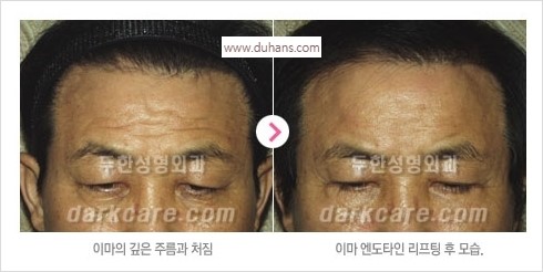 [두한성형외과 경쟁력 주름성형] - [주름제거와 볼륨을 갖게하는 엔도타인 리프팅] 관련 이미지 24