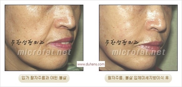 [두한성형외과 경쟁력 지방이식] - [두한 자가지방이식 클리닉 안내]​ 관련 이미지 42