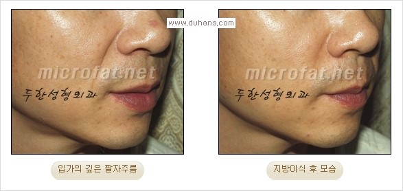 [두한성형외과 경쟁력 주름성형] - [코 옆과 입가에 걸쳐서 형성된 주름을 교정해주는 미세지방이식] 관련 이미지 7