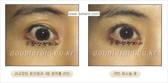 [두한성형외과 경쟁력 쌍꺼풀 재수술, 극한 눈재수술] - [망가진 쌍꺼풀 라인을 교정하는 극한 재수술을  위한 계획] 관련 이미지 3