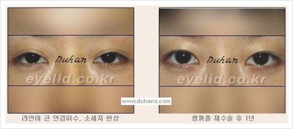 [두한성형외과 경쟁력 눈성형] - [안검하수와 몽고주름에 대한 자주하는 질문과 답변] 관련 이미지 11