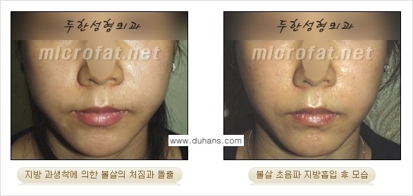 [두한성형외과 경쟁력 지방흡입] - [얼굴, 볼살, 턱살, 턱선의 초음파 지방흡입] 관련 이미지 16
