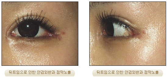 [Duhan Plastic Surgery Double Eyelid Revision] - [Inner Corner Revision, Outer Corner Revision] image 8