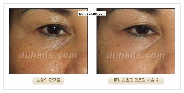 [두한성형외과 경쟁력 주름성형] - [HIFU 초음파 리프팅 주름교정술 안내 2.] 관련 이미지 19