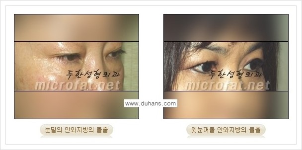 [두한성형외과 경쟁력 지방제거] - [눈밑(눈위)지방제거, 눈꺼풀(윗눈꺼풀)지방제거 안내 ①] 관련 이미지 1