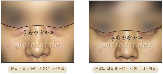 [두한성형외과 지방이식] - [다크서클, 눈밑주름] 관련 이미지 5
