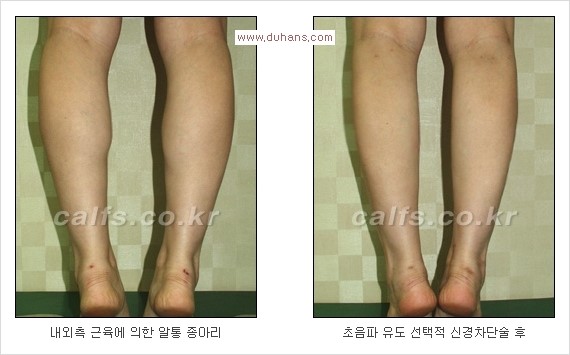 [두한성형외과 Dr. 컬럼] - [종아리 근육퇴축술로 가장 선호하는 비절개 초음파 유도 선택적 신경차단술] 관련 이미지 11