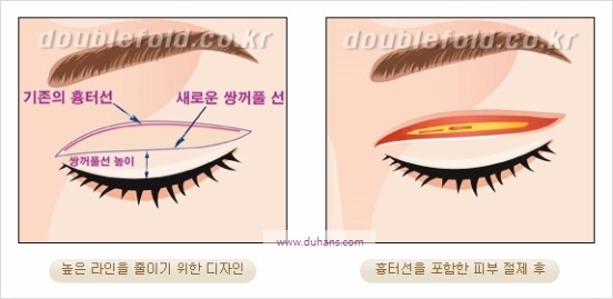 [두한성형외과 경쟁력 눈성형] - [쌍꺼풀 재수술에 대한 최선의 대안 제시] 관련 이미지 5