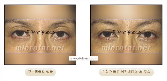 [두한성형외과 경쟁력 쌍꺼풀 재수술, 극한 눈재수술] - [어색한 쌍꺼풀 라인을 교정하는 윗눈꺼풀 미세지방이식] 관련 이미지 20