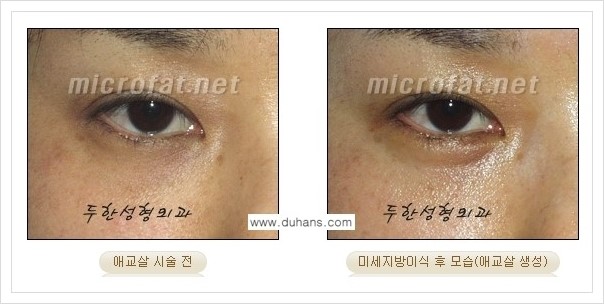 [두한성형외과 경쟁력 눈밑성형] - [눈밑 애교살 미세지방이식 안내] 관련 이미지 6