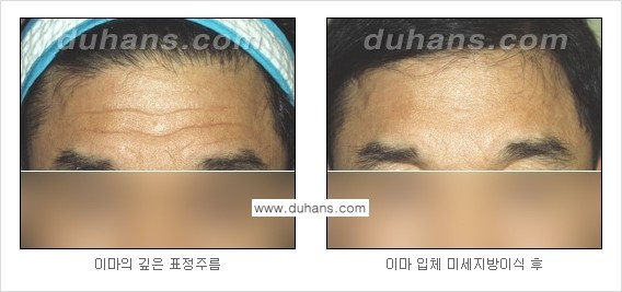 [두한성형외과 경쟁력 주름성형] - [지방이식을 이용한 이마주름, 미간주름 제거] 관련 이미지 11
