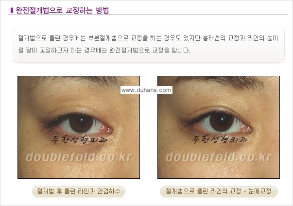 [두한성형외과 NO.1 경쟁력 눈성형] - [풀린 쌍꺼풀 절개법으로 교정하는 방법] 관련 이미지 1