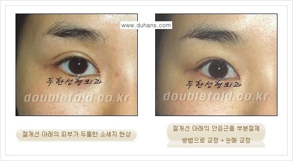 [두한성형외과 경쟁력 쌍꺼풀 재수술] - [절개선 아래가 두툼한 소세지 현상 + 눈매교정 안내] 관련 이미지 3