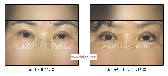 [두한성형외과 경쟁력 눈성형] - [쌍꺼풀 재수술] 관련 이미지 1