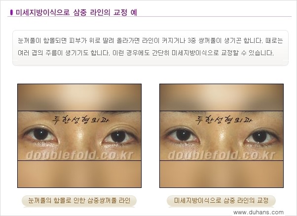 [두한성형외과 NO.1 눈성형] - [함몰된(꺼진) 눈꺼풀에서 쌍꺼풀 라인 교정 4.] 관련 이미지 1