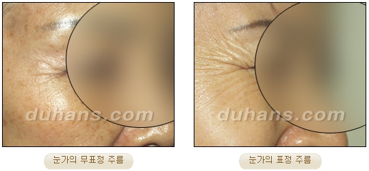 [Duhan Plastic Surgery Wrinkle Removal] - [Wrinkle Removal Treatment Methods] image 4